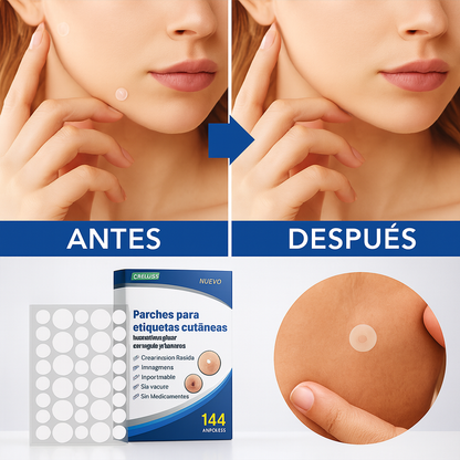 SkinClear - 144 Parches Removedor de Verrugas y Lunares